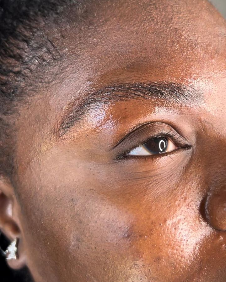 Depois, cicatrizado: pele escura, sobrancelhas finas